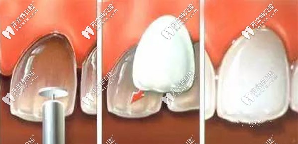 先說下全瓷貼面的品牌及價格