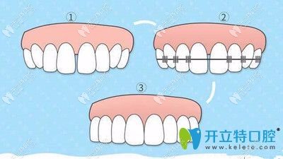 牙間隙過大怎么治療