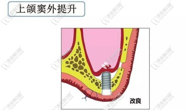上颌窦外提升示意图