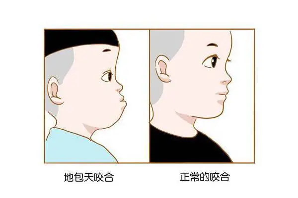 兒童地包天對(duì)比圖m.kelete.com