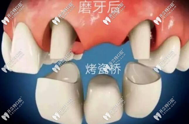 连桥冠