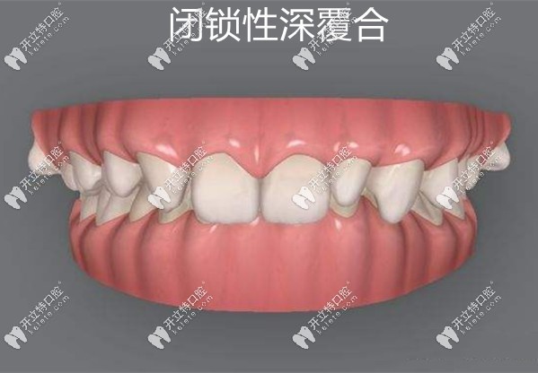 閉鎖性深覆合癥狀