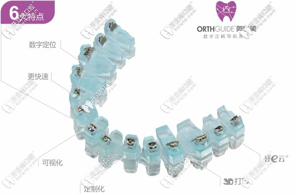 奥世美矫正器的优势特点