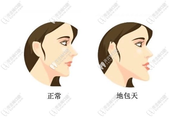 兒童地包天矯正需要多久