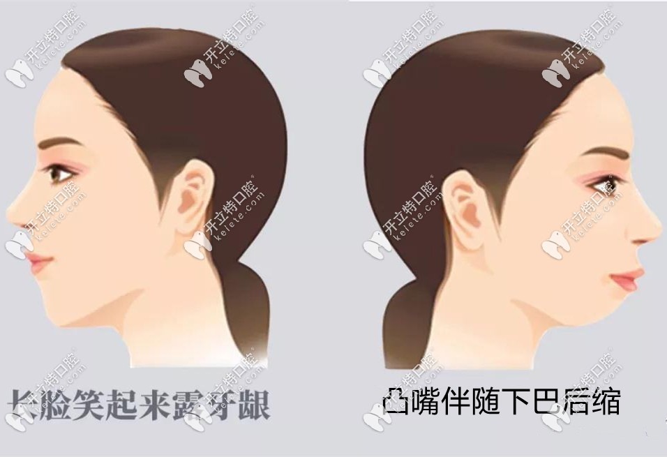遺產(chǎn)因素也會(huì)導(dǎo)致下頦發(fā)育不良