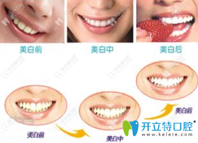 皓齒美白牙齒的步驟