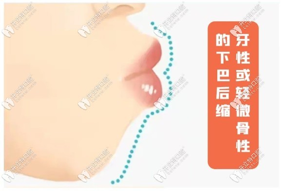 牙性或輕微骨性的下巴后縮示意圖