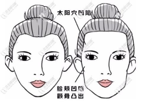 牙套臉的圖片