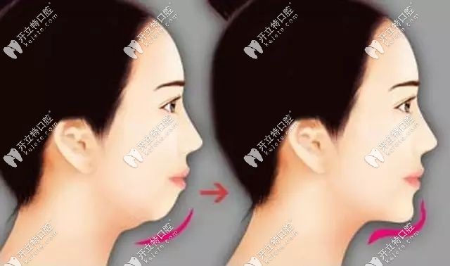 下巴后縮和正常下巴對(duì)比圖