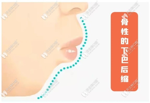 中/重度骨性的下巴后縮