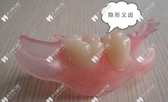 隱形牙齒圖片展示