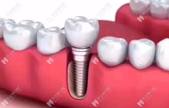 口腔種植