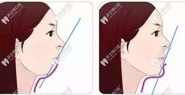 下和短小后縮的側(cè)貌