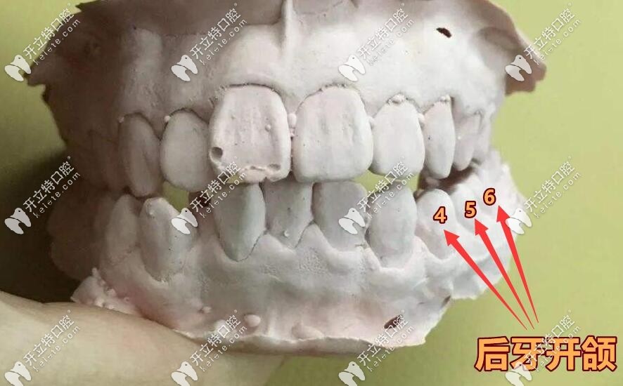 后牙開頜不能嚼東西