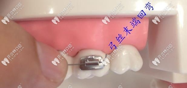 正畸鋼絲滑出