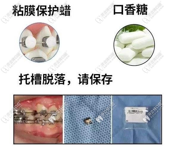 托槽掉落的處理方式