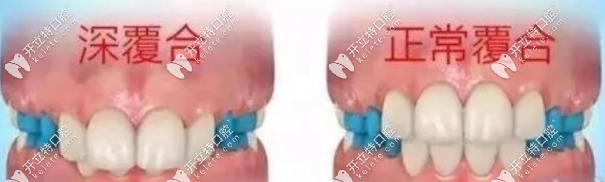 深覆合矯正前后對比