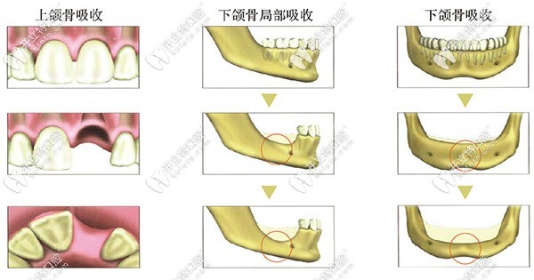 牙齒各部位牙槽骨吸收示意圖