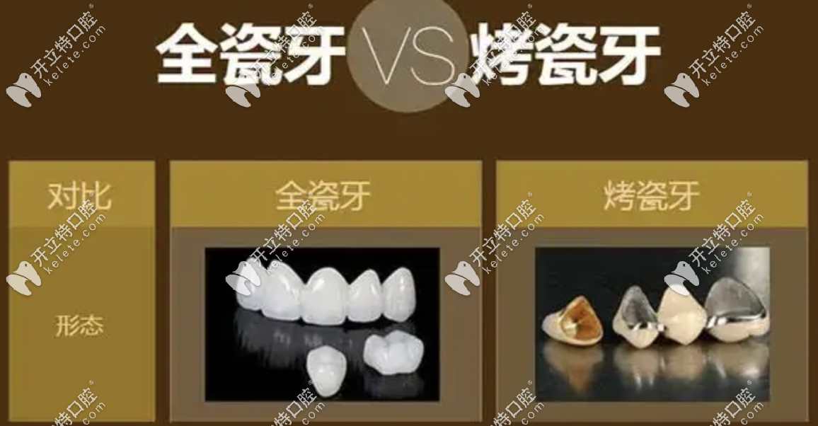 全瓷牙和烤瓷牙區(qū)別及壽命