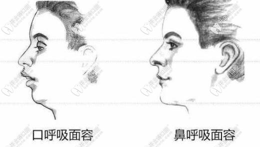 凸嘴口呼吸矯正前后結(jié)果