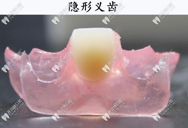 隱形義齒的優(yōu)缺點(diǎn)