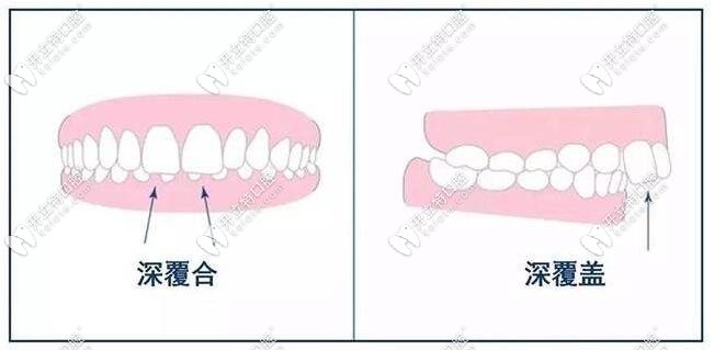 乳牙深覆合有必要矯正嗎？