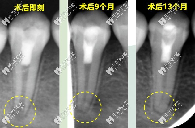 牙髓再生術前后對比病例圖