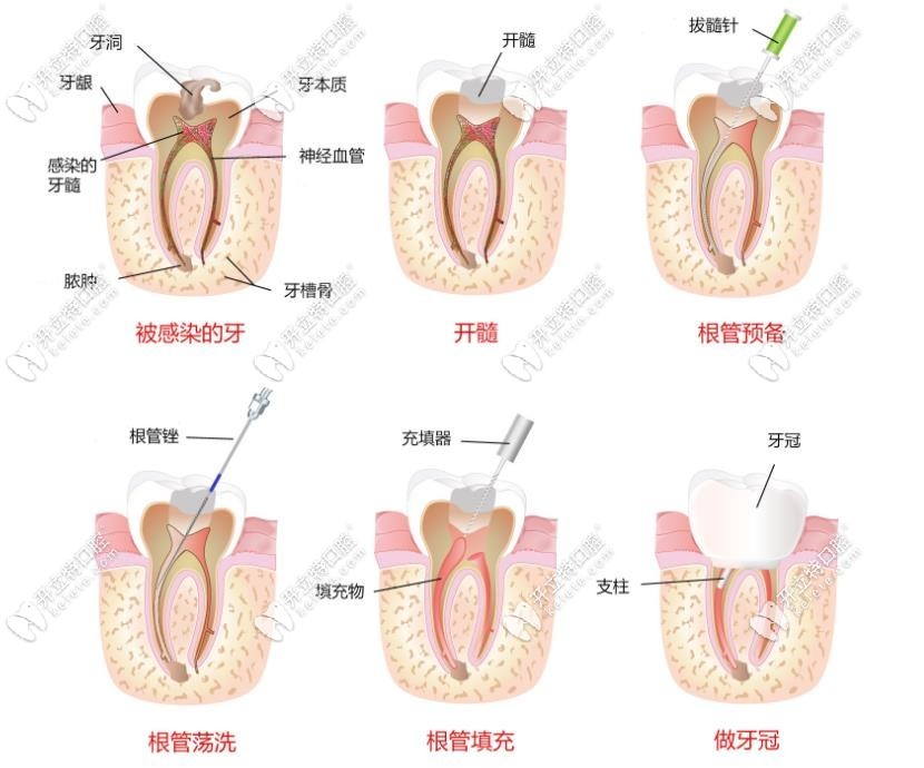 根管超聲蕩洗的流程示意圖