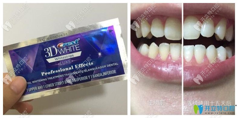 美白牙貼有用嗎