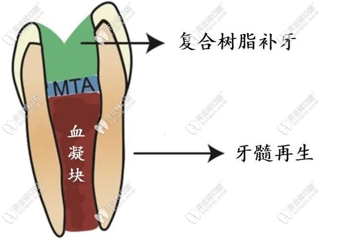 牙髓再生術示意圖