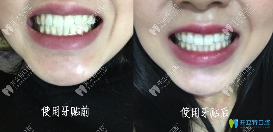 使用美白牙貼前后對(duì)比照片