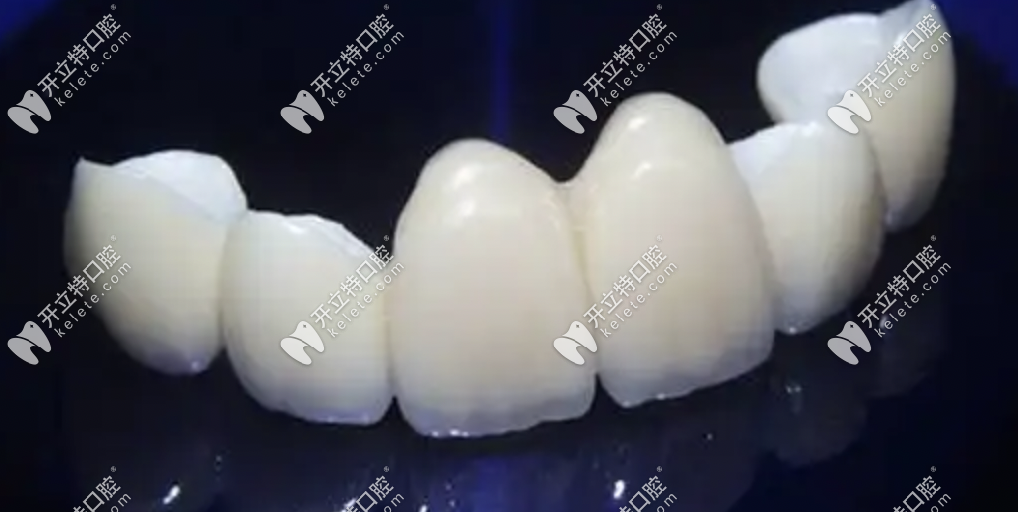 全瓷牙使用壽命20年左右