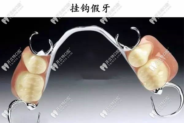 掛鉤假牙好不好