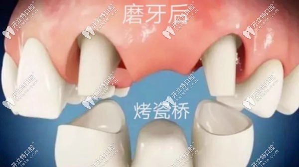 烤瓷牙的使用寿命