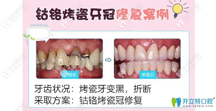 钴铬烤瓷牙修复案例