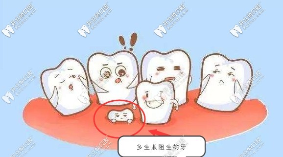 超出正常牙數的阻生牙是需要拔掉的