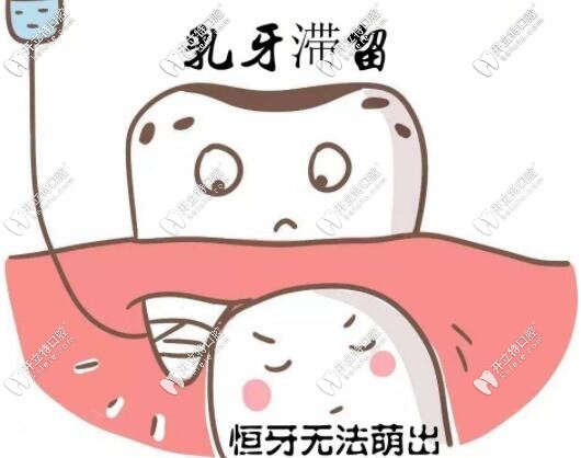 乳牙滯留隱形恒牙萌出