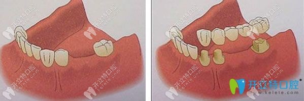 活动假牙的修复过程