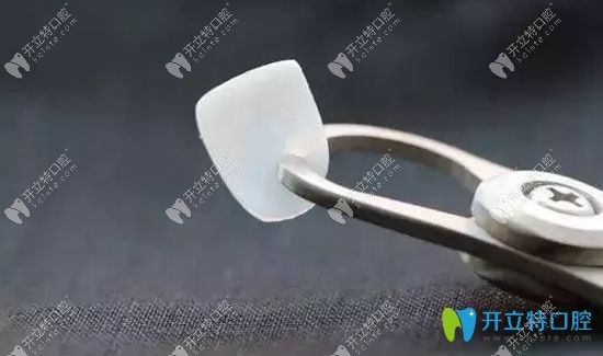 超薄牙贴面展示图