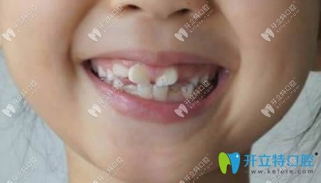 小孩新出恒牙長歪圖片