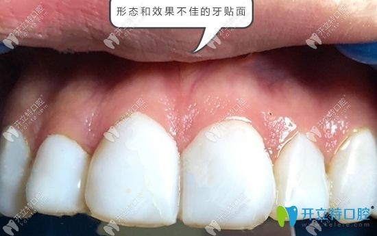 形态和颜色不佳的牙齿贴面<span style=