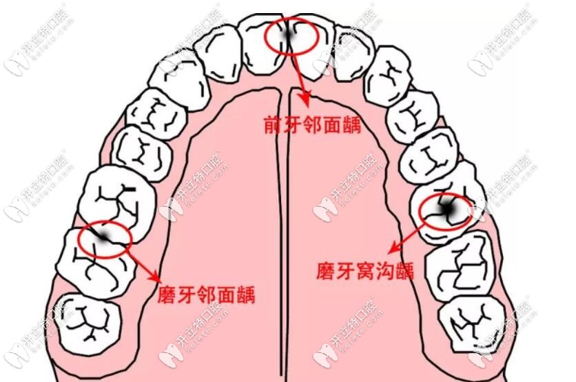 合面窩溝齲
