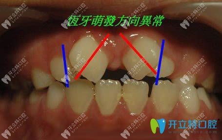 小孩新出恒牙長歪怎么辦