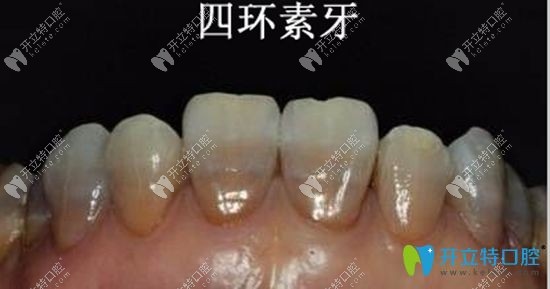 四环素牙齿的<span style=