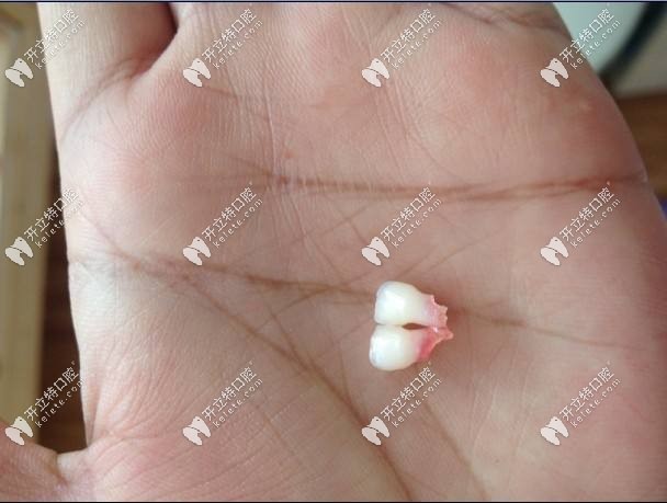老人夢到自己掉了一顆牙是什么原因