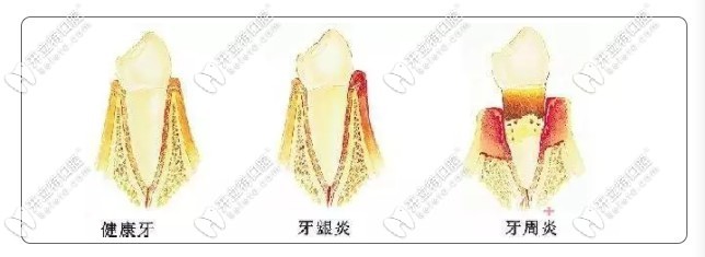 牙周炎導致牙齒松動掉落示意圖