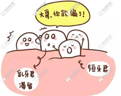 乳牙還沒(méi)掉，恒牙就長(zhǎng)出來(lái)圖片