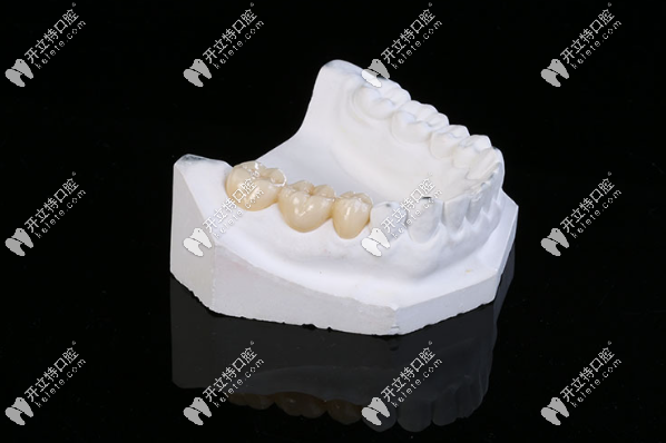 全瓷牙套