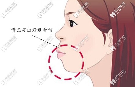 嘴巴突出，侧脸难看