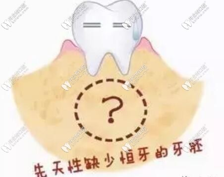 先天性缺少恒牙